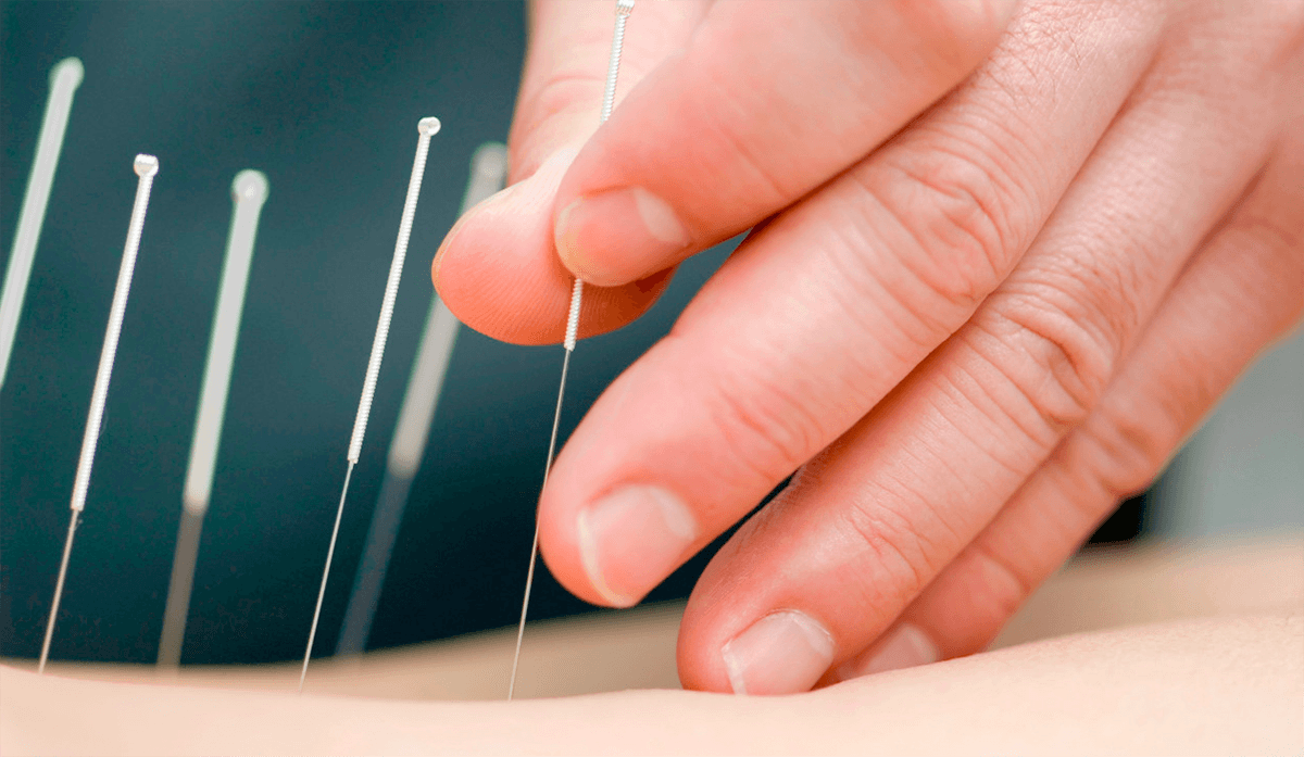Taller de acupuntura para el tratamiento del dolor